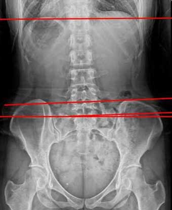 3개월 후 척추 골반 X-ray